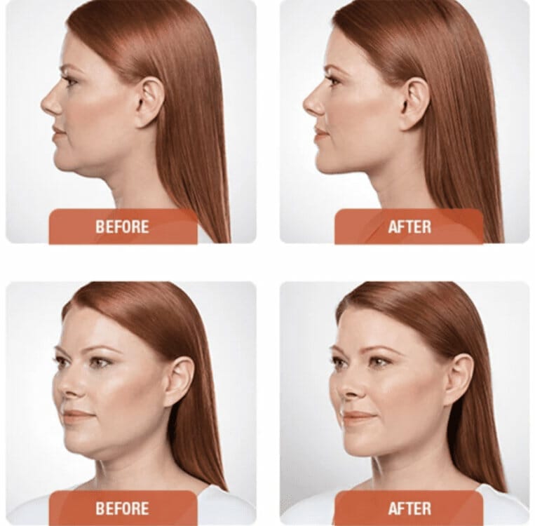 Kybella in Orlando - photo of results