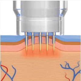 potenza infusion tip for hair restoration
